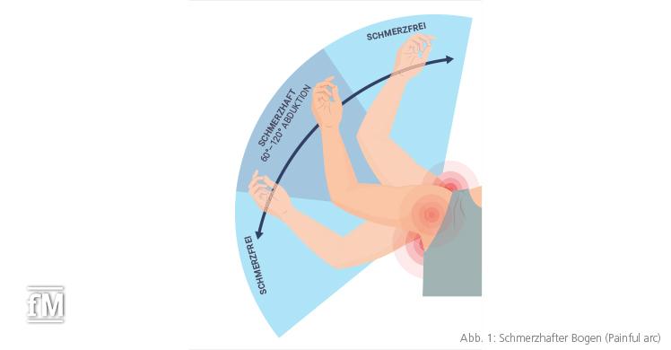 Abb. 1: Schmerzhafter Bogen (Painful arc)