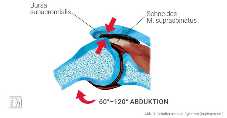 Abb. 3: Schulterengpass-Syndrom (Impingement)